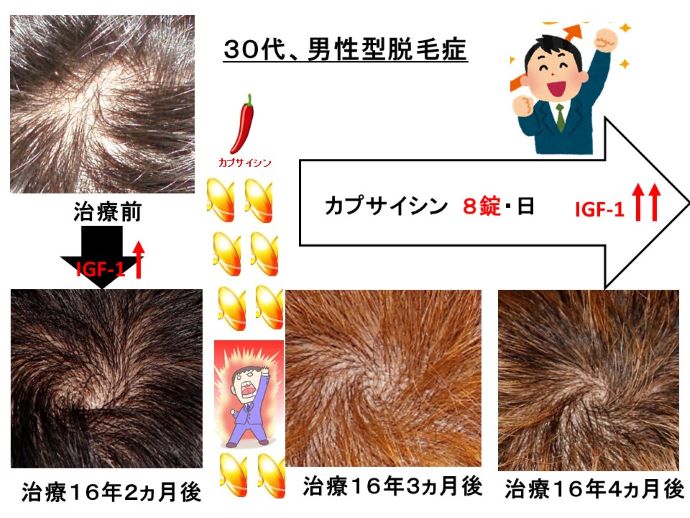 円形脱毛症　病院